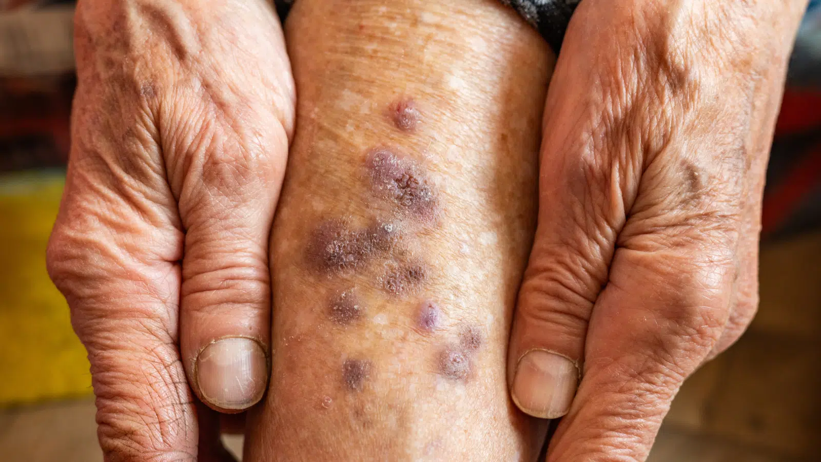 Common Skin Conditions in Older Adults Feature Image: Eldery woman shows leg with skin disease.