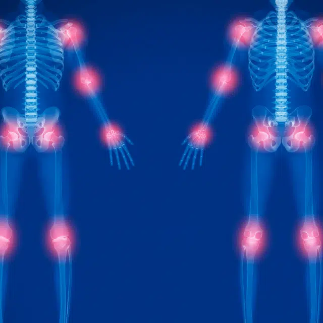 Managing Arthritis Joint Pain Effectively
